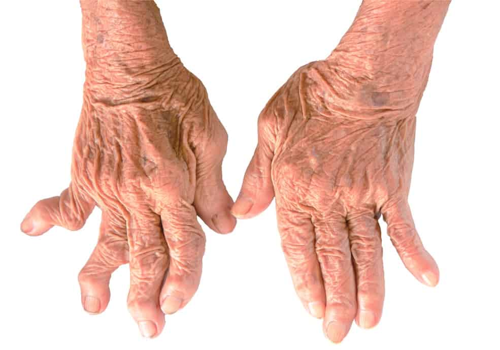 Mano affetta da Artrite Reumatoide